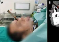 15厘米断竹插入男子眼眶直抵颅内 画面曝光简直太吓人了