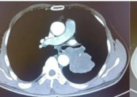男子咳嗽1个月没在意 一查确诊癌症 实在太意外了