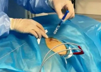 男子确诊肺癌医生一根针冻死癌细胞 到底是不是真的？