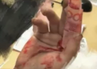 男子手指受伤用百元大钞包着止血 究竟是怎么回事？
