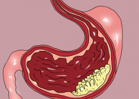 24岁女生没食欲 一查全胃长满肿瘤 原因竟是这样太吓人了