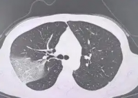 女子硬扛高烧3天变白肺 为什么这么严重？