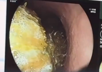 女生患异食癖连吃6年塑料袋 究竟是怎么回事？