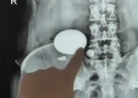 女子不爱喝水尿液浓缩成鹅卵石 究竟是怎么回事？