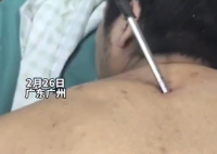 高空掉落30cm螺丝刀直插男子胸腔 从背后直插入胸腔