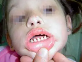长哪吒同款鲨鱼牙可能患有罕见病 究竟是怎么回事？