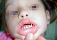 长哪吒同款鲨鱼牙可能患有罕见病 究竟是怎么回事？