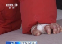 女孩确诊“蝴蝶宝贝”皮肤一碰就碎 究竟是怎么样的？