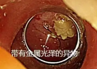 老人突发高烧拍胸片意外发现鱼钩 事件始末2025最新消息