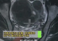 女子爱生闷气子宫里长了8个瘤 内幕实在让人惊个呆