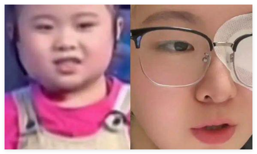 知名童星“秦虹一枝花”右眼失明 为什么失明什么情况？